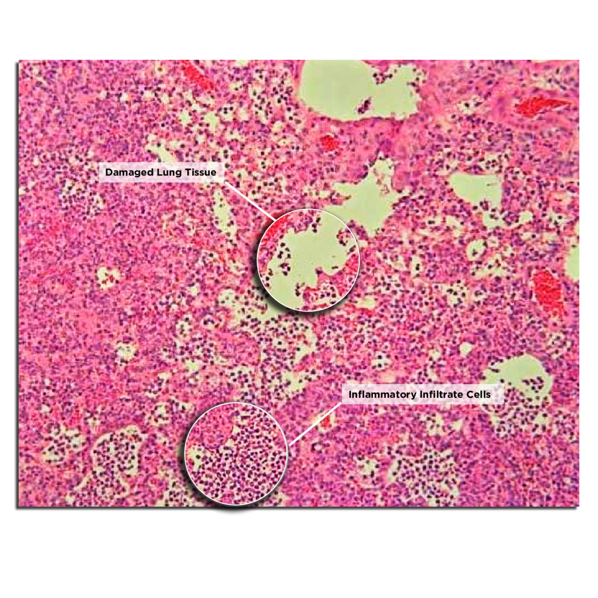 Histology image of a section of mouse lung infected with the reconstructed 1918 pandemic influenza virus, 2004 (labeled)
